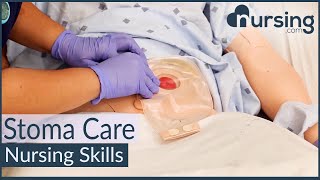 Stoma Care Changing a Colostomy Bag Nursing Skills [upl. by Horbal]