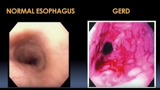 Diagnosis and Treatment for Esophageal and Motility Disorders Video  Brigham and Womens Hospital [upl. by Tremain]