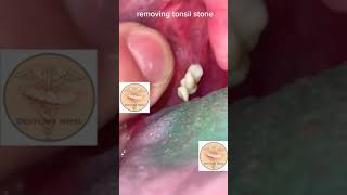 Tonsil Stone REMOVAL AT HOME [upl. by Sperling323]