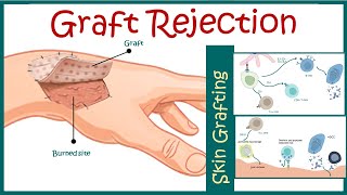 Graft rejection  Immunological basis of graft rejection [upl. by Alehtse]