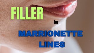 FILLER for MARIONETTE LINES  injection technique revealed [upl. by Airamzul815]