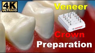 Veneer and Crown Prep StepbyStep [upl. by Irah]