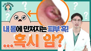 피부암피부암초기사진피부암점피부암증상피부암초기증상피부암사망률흑색종피부혹 [upl. by Llenet]