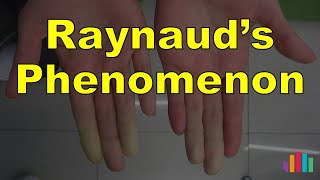 Raynauds Phenomenon [upl. by Beitch206]