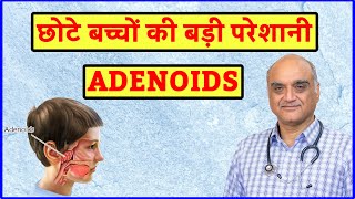 Adenoids kya hota hai । Enlarged adenoids । बच्चों में खराटे । Hindi [upl. by Devan402]