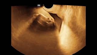 caudal regression syndrome fetal ultrasound with phocomelia of lower extremeties [upl. by Lesslie]