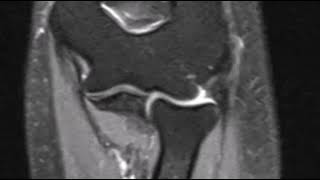 Lateral epicondylitis of elbow [upl. by Stearne]