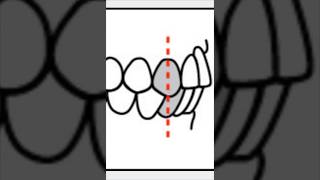 Angles Classification  Canine Relationship [upl. by Ojybbob]