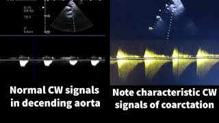 Coarctation of aorta [upl. by Alahc]