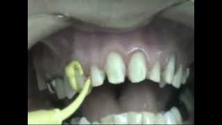 Impression for dental veneers [upl. by Eedeed]