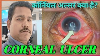 कॉर्नियल अल्सर और उनका उपचार  Corneal Ulcer Causes Symptoms amp Treatment Options [upl. by Hartmunn]