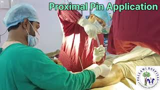 Ankle Spanning External Fixation PallawiHospital2023 mancherial orthopaedicsurgeon viral [upl. by Melloney408]