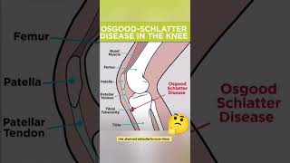 What is Osgood  Schlatter Disease physiotherapypainmodalitiesyoutube [upl. by Tonkin76]