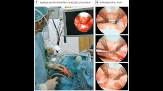 Headache Treatment Using Endoscopic Nerve Decompression [upl. by Dublin673]