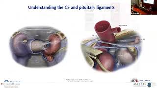 Revisiting Operability Within the Cavernous Sinus  MASSIN Congress Day 3  Session 12 Talk 2 [upl. by Merce442]