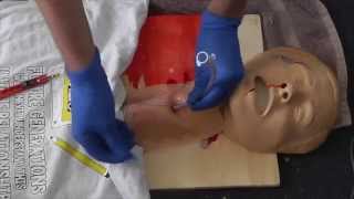 Cricothyroidotomy [upl. by Tarfe713]