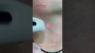 Laser Hair Removal getsmarthairclub skincare viralvideo [upl. by Jecon859]