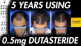 Dutasteride after 5 years Long Term StudyIT WORKS malepatternbaldness androgenicalopecia [upl. by Meela]