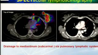 Lymphoscintigraphy with SPECTCT in Malignant Melanoma [upl. by Evonne949]