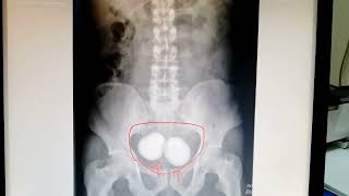 What is this see the kub xray xraysubscribe 🙏🙏🙏 health viralvideo urineanalysisdoctor [upl. by Gratt77]