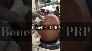 HAIR FALL❌ PRP ✅prp prphairgrowth skincare hair hairdensity increase haircare haircare [upl. by Spiegleman]