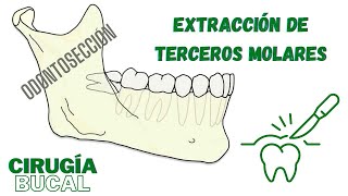 ODONTOSECCIÓN Técnica de extracción de Terceros Molares  Dr Han Choi [upl. by Feodora804]