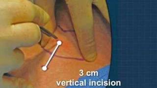 Cricothyrotomy [upl. by Avruch685]