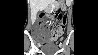 Small bowel ischemia associated with a parastomal hernia postileostomy in a Crohns disease patient [upl. by Novak]