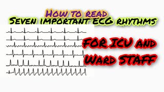 ECG rhythms [upl. by Yrem]