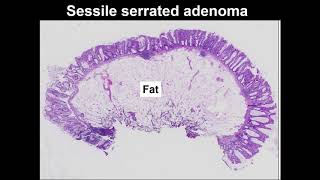 Serrated polyps Learn to tell the difference between hyperplastic polyp and sessile serrated lesion [upl. by Domph]