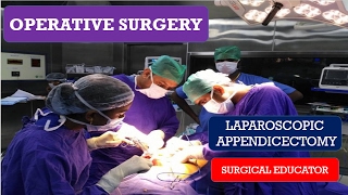 LAPAROSCOPIC APPENDICECTOMY STEP BY STEP Operative Surgery [upl. by Kihtrak]