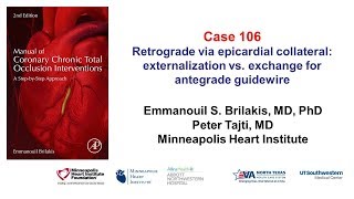 Case 106 Manual of CTO interventions Retrograde via epicardial collateral [upl. by Hapte]