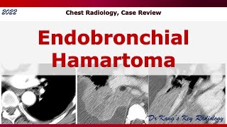 Endobronchial Hamartoma [upl. by Ohploda732]