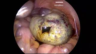 Ovarian Torsion by Dr Gajanan Patil  Kewal Hospital  Laparoscopy Training [upl. by Frohman]