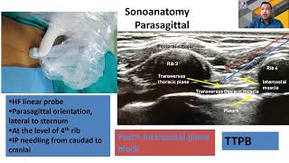 Fascial plane blocks for thoracic surgery  Dr Ritesh Roy  ISACON Kerala 2021 [upl. by Hajidahk]