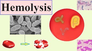 Anemia Lesson 3  Hemolysis [upl. by Dannie]