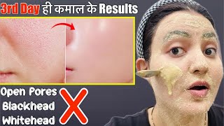 Glass Skin Transformation Series Day 3  Remove Open Pores Blackhead Whitehead in 5 Days💕 [upl. by Litt]