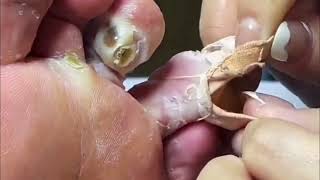 Pedicure video27，vertical plantaris，plantar wart [upl. by Ilam]