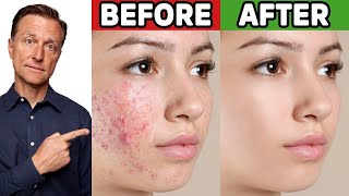 The Best Trick for Clear Skin Acne Aging Wrinkles Liver Spots [upl. by Cate658]