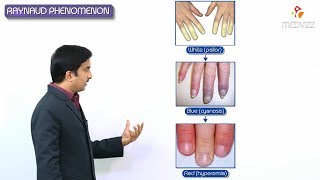 Raynauds phenomenon  Raynauds disease amp Raynauds syndrome [upl. by Braasch]