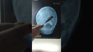 Mastoid process Air sinuses MBBS Life 🩺 MBBS practical time mbbs neet motivation trending [upl. by Bael]