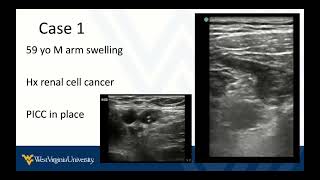 DVT POCUS 5  Upper Extremity DVT and Summary [upl. by Enelahs]