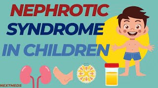 Nephrotic Syndrome In ChildrenCausesSigns And SymptomsDiagnosisTreatmentPaediatrics [upl. by Adrahs968]