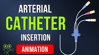 ARTERIAL CATHETER INSERTION  PLACEMENT  ANIMATION [upl. by Spielman903]