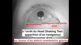 Head Shaking Test nystagmus droit déficit vestibulaire gauche [upl. by Verdie]