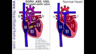 38 Double Outlet Right Ventricle with ASD VSD bicuspid aortic [upl. by Netti]