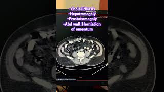 Cholelithiasis Hepatomegaly Prostatomegaly Abd wall Herniation of omentum trending ctscan [upl. by Novihs]