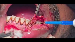 Verrucous carcinoma lip excision cautery laser  Dr Hitesh Patel [upl. by Adnirol]