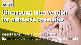 US intervention for adhesive capsulitis targeting coracohumeral ligament and inferior capsule [upl. by Lahcym138]