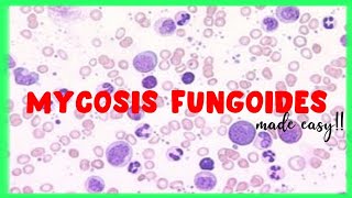 Mycosis Fungoides  WBC disorders  Sezary Syndrome [upl. by Anyk]